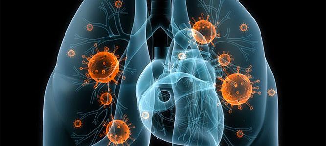 Lung Cancer | PDC*line Pharma